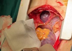 heart and liver tumor1 (1)