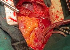 heart and liver tumor1 (4)