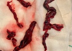 photo pulmonary TEP covid