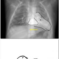 TOF with pericardial agenesis