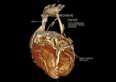 Atretic coronary venous sinus ostium 1