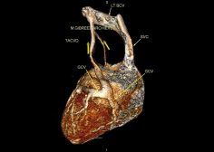 Atretic coronary venous sinus ostium 2