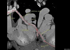 Atretic coronary venous sinus ostium 3