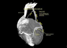 Atretic coronary venous sinus ostium 4