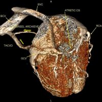 Atretic coronary venous sinus ostium, TACVD