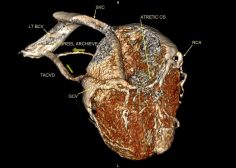 Atretic coronary venous sinus ostium 5