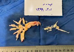 Chronic Thromboembolic Pulmonary HTN 4