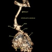 Hypoplastic LV, LVOT & AORTA