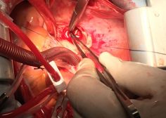 IVC occlusion due to Tumoral involvement in PMH 2