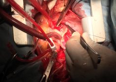 IVC occlusion due to Tumoral involvement in PMH 3