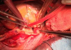 IVC occlusion due to Tumoral involvement in PMH 4