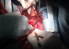 IVC occlusion due to Tumoral involvement in PMH 5