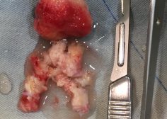 IVC occlusion due to Tumoral involvement in PMH 6