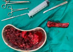 Primary Neuro Ectodermal Tumor PNET of ribs invaded IVC 1