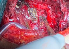 Primary Neuro Ectodermal Tumor PNET of ribs invaded IVC 2