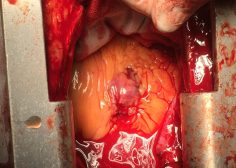 Spontaneous RT coronary artery free rupture and hematoma