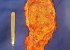 Tumor in huge LT pulmonary artery epicardial trunc space 2