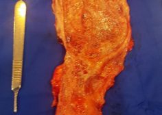 Tumor in huge LT pulmonary artery epicardial trunc space 3