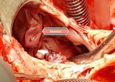 coronary sinus abcess formation 1