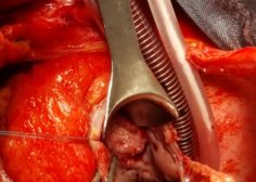 coronary sinus abcess formation 2