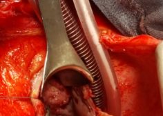coronary sinus abcess formation 3