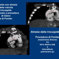 Glenn and Fontan on Tricuspid Heart Valve Atresia