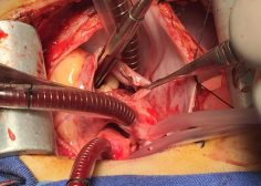 tricuspid valve bacterial endocarditis and vegetation in pediatric population 1