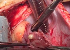 tricuspid valve bacterial endocarditis and vegetation in pediatric population 3