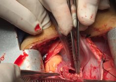 tricuspid valve bacterial endocarditis and vegetation in pediatric population 4