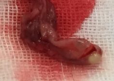 tricuspid valve bacterial endocarditis and vegetation in pediatric population 5