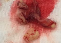 tricuspid valve bacterial endocarditis and vegetation in pediatric population 6