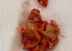 tricuspid valve endocarditis