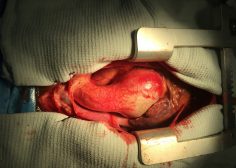 Marfan syndrome and ascending aorta aneurysm 1