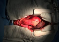 Marfan syndrome and ascending aorta aneurysm 2