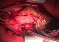 Marfan syndrome and ascending aorta aneurysm 3