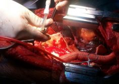 Marfan syndrome and ascending aorta aneurysm 4