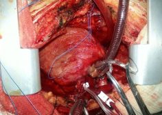 Pancarditis specially involving right heart site with mucormycosis after covid 19 1