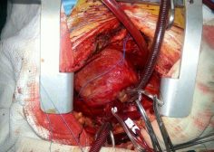 Pancarditis specially involving right heart site with mucormycosis after covid 19 3