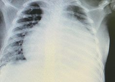 Pus filled pericardial effusion