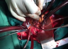 Retrograde expansion of lung tumor 1