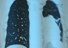 Retrograde expansion of lung tumor 10