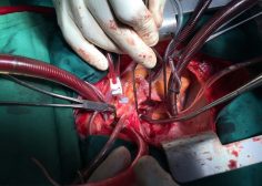 Retrograde expansion of lung tumor 2