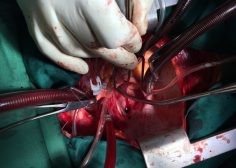 Retrograde expansion of lung tumor 3