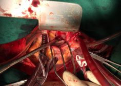Retrograde expansion of lung tumor 4