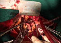 Retrograde expansion of lung tumor 5