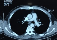 Retrograde expansion of lung tumor 6