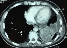 Retrograde expansion of lung tumor 7