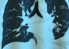 Retrograde expansion of lung tumor 8