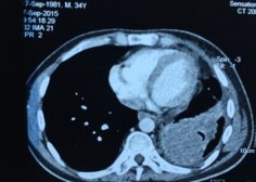 Retrograde expansion of lung tumor 9