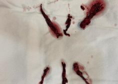 Single incision pulmonary trunc and LPA and RPA and RA embolectomy